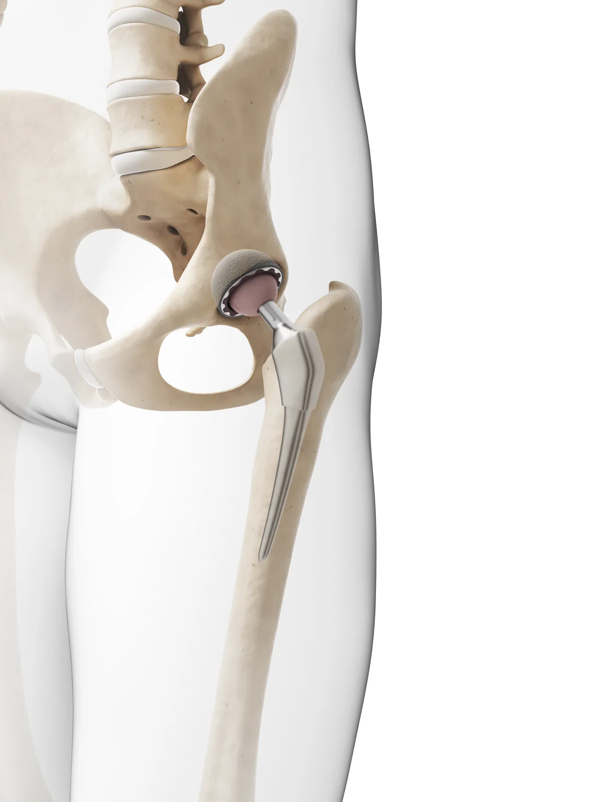 Medical illustration of a hip replacement implant